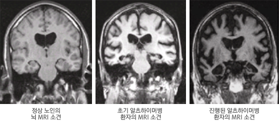 알츠하이머병 MRI 영상