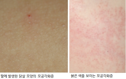 모공각화증