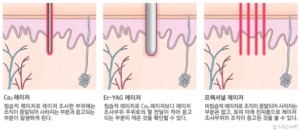 레이저 종류별 피부조직에 나타나는 반응의 차이