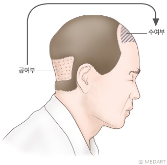 자가모발이식 모식도