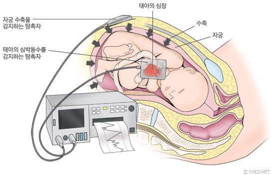 태동 검사 모식도