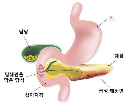 급성 췌장염