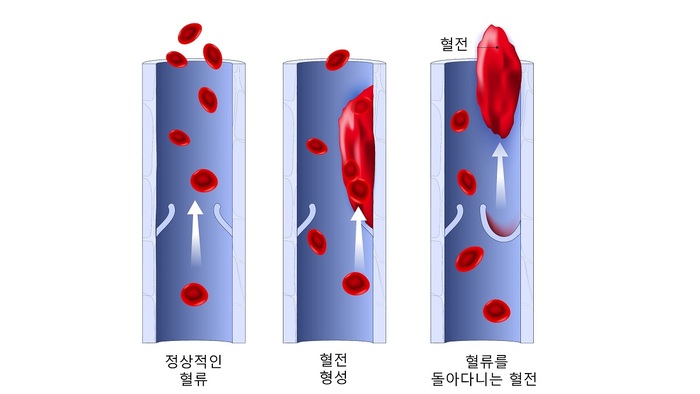 혈전