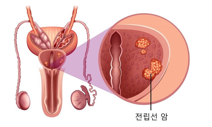 전립선암
