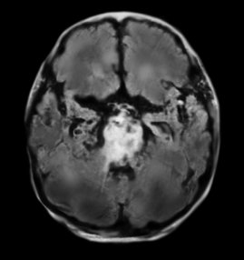 감금증후군 뇌 MRI: 교뇌를 전반적으로 침범한 뇌경색