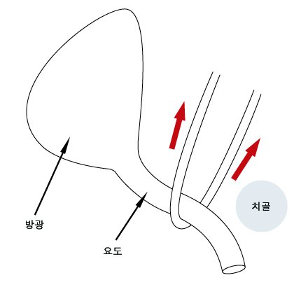 중부요도 슬링 수술
