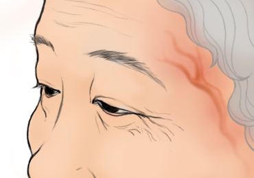 측두동맥염이 잘 발생하는 얕은 측두동맥의 위치