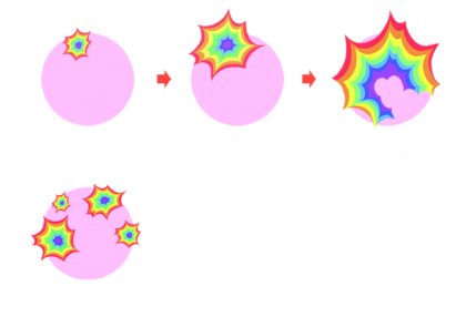 시야 한 쪽에서 번쩍거림이 점차 커짐. 간혹 4번째 그림처럼 시야 주변에서 다발성으로 발생하기도 함