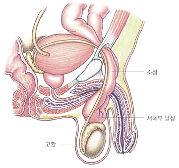 서혜부 탈장 모식도