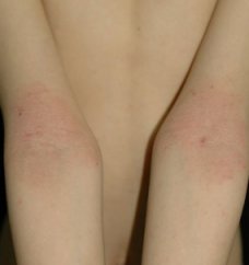 팔 접히는 부분의 아토피 피부염