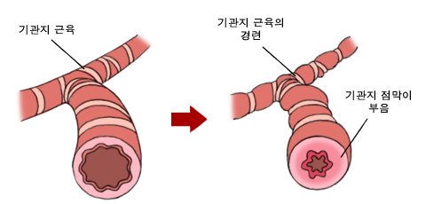 기관지 염증