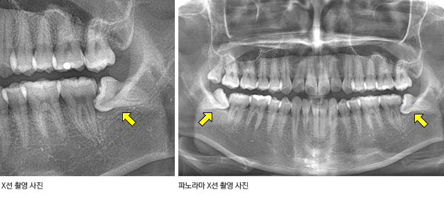 제3대구치 방사선 검사