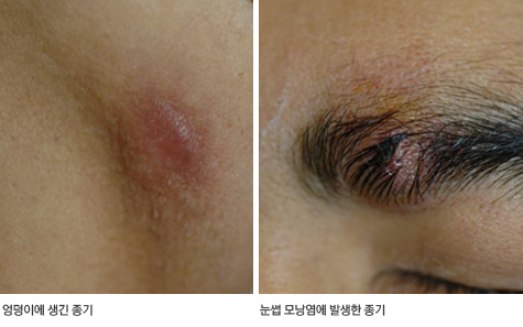 종기 증상