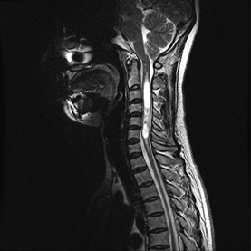 경추에 발생한 척수 공동증 MRI: 척수 내에 하얗게 보이는 것이 뇌척수액이 고여 형성한 수종임