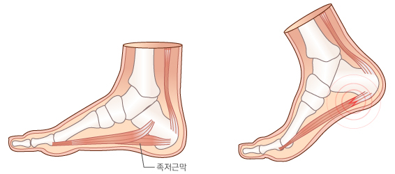 족저근막염 발생 부위