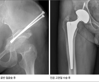 고관절염 치료 후 X선 영상