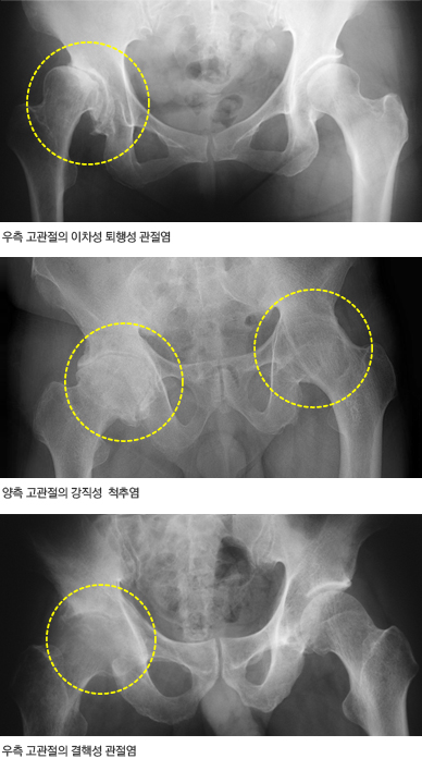 고관절염 X선 영상