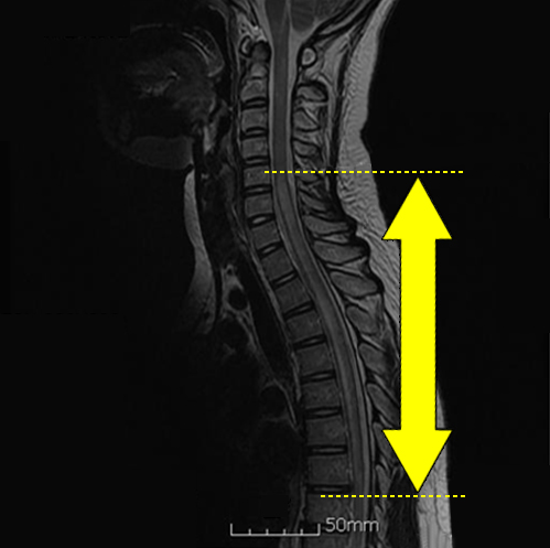 척수염 MRI