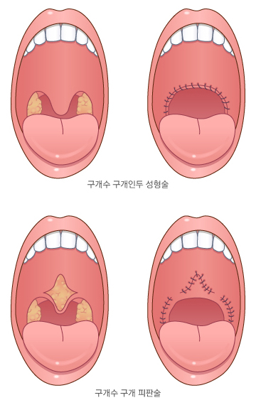 구개수 구개인두 성형술과 구개수 구개 피판술