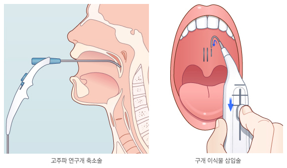 고주파 연구개 축소술과 구개 이식물 삽입술