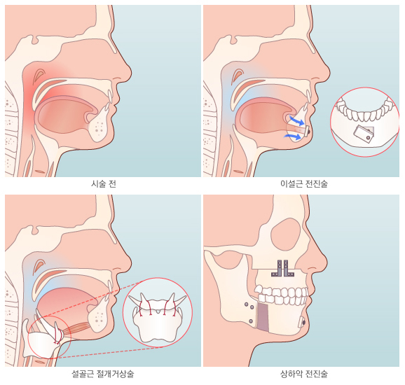 이설근 전진술, 설골근 절개거상술, 상하악 전진술