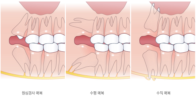 매복된 각도에 따른 사랑니 분류
