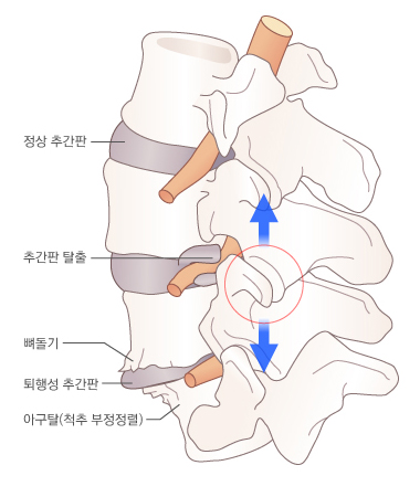 후관절을 신장시킴