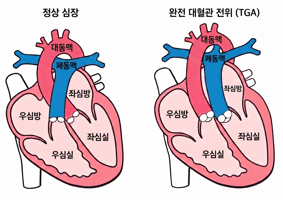 서울대병원-전남대병원, 완전 대혈관 전위 수술 후 장기 안정성 확인