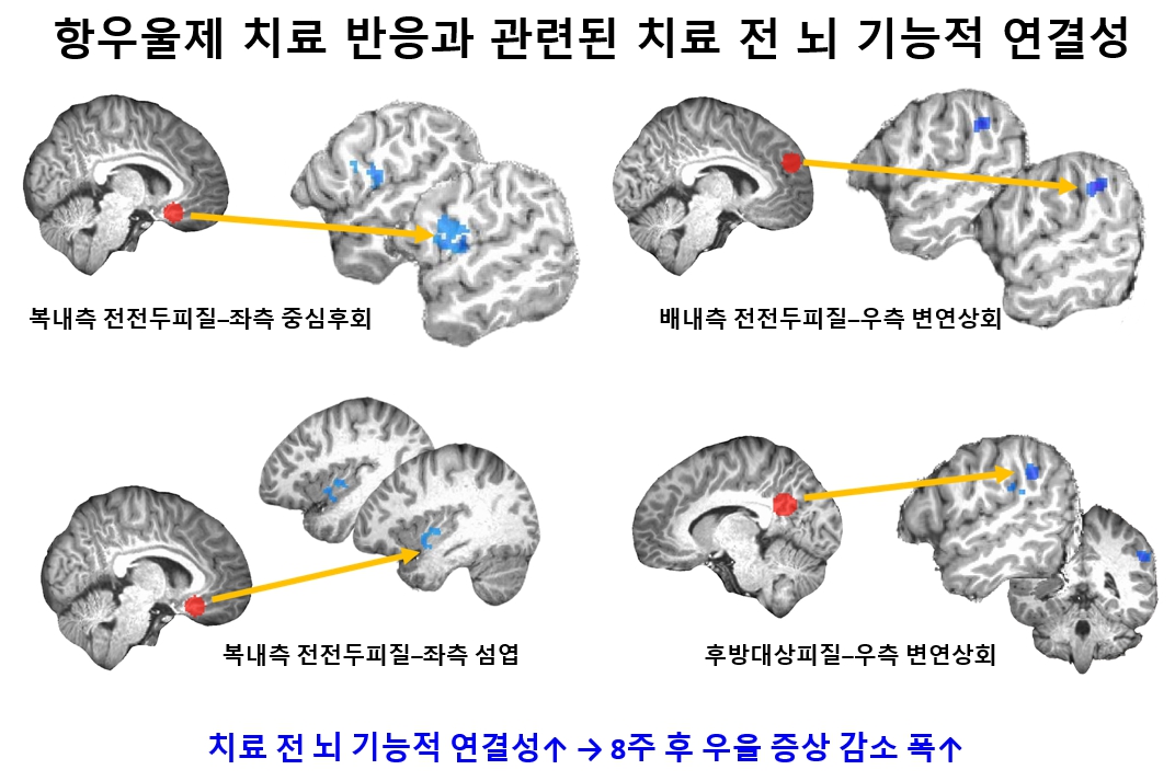 청소년 우울증 항우울제 치료 반응, 치료 전 ‘뇌 기능적 연결성’으로 예측한다