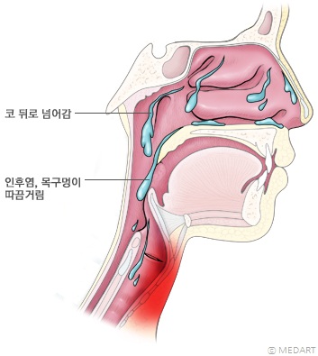 후비루 모식도