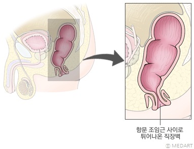 직장 탈출증의 원인