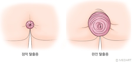 직장 탈출증의 종류
