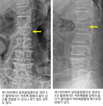 압박골절의 X선 촬영