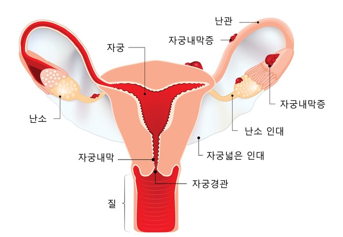 자궁내막증