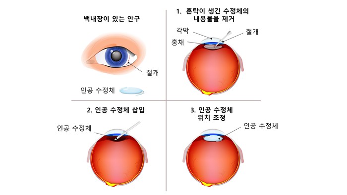 백내장 수술