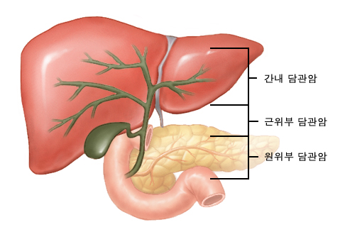 담관암 발생 위치