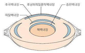 백내장의 종류
