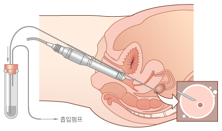 시험관 아기 시술 방법